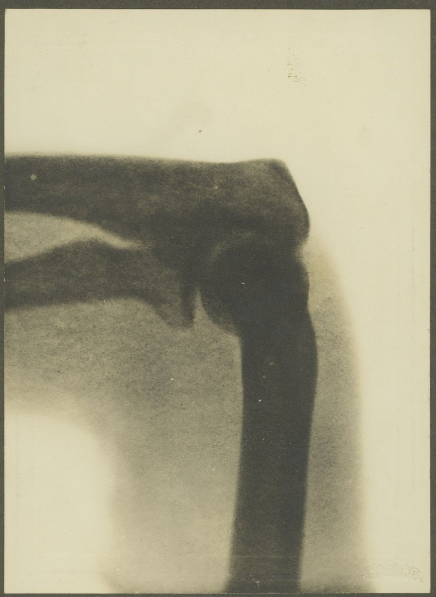 X-rays taken on first x-ray machine at Melbourne Hospital, Melbourne City (1900–10)