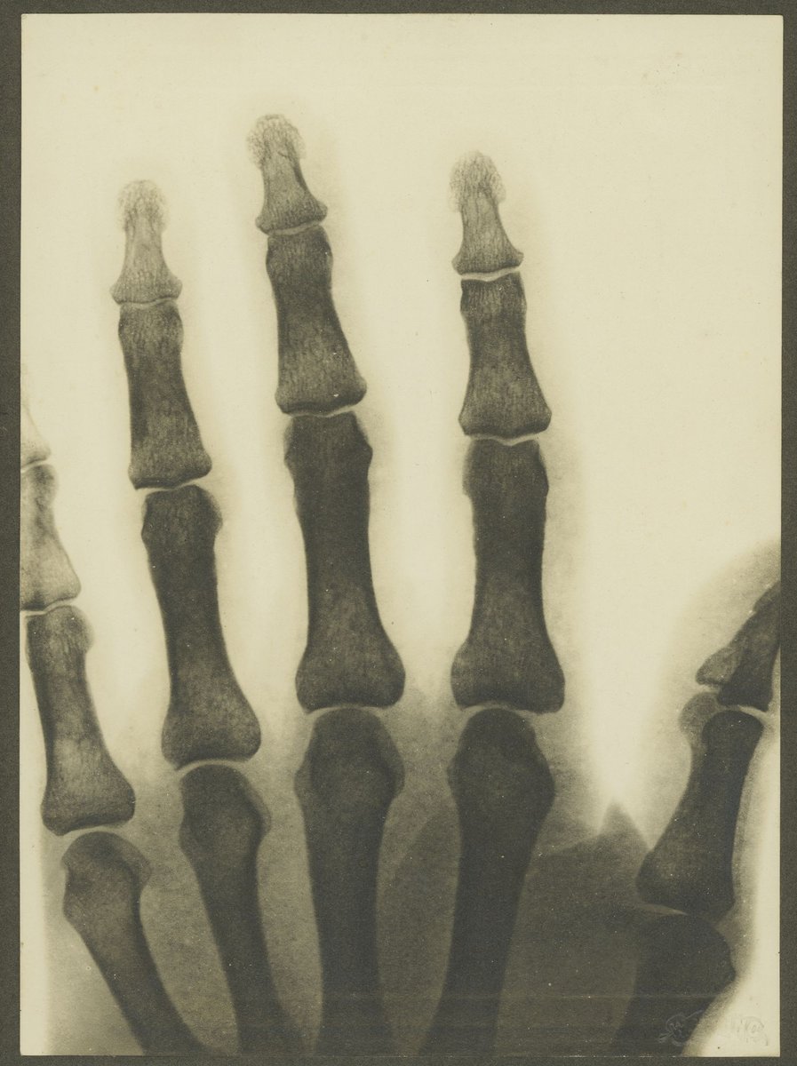 X-rays taken on first x-ray machine at Melbourne Hospital, Melbourne City (1900–10)