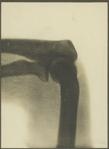 X-rays taken on first x-ray machine at Melbourne Hospital, 1900–10