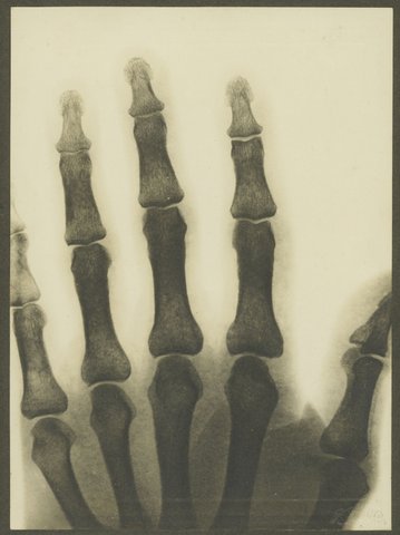 X-rays taken on first x-ray machine at Melbourne Hospital, 1900–10